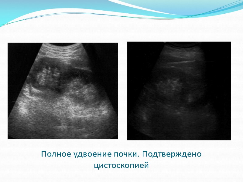 Полное удвоение почки. Подтверждено цистоскопией